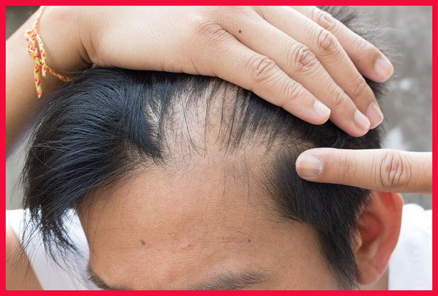 وصفات بذور الكتان لإنبات فراغات الشعر و علاج الثعلبة