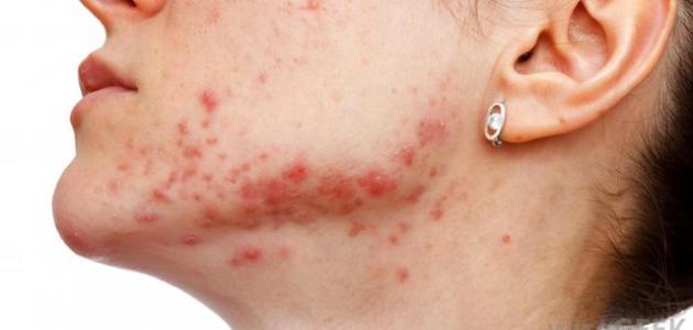 علاج حب الشباب Acne