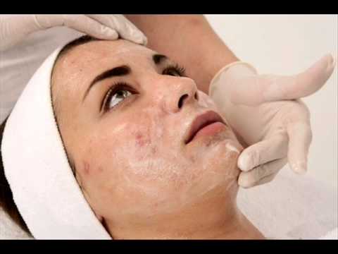 علاج حب الشباب Acne بالطرق الطبية