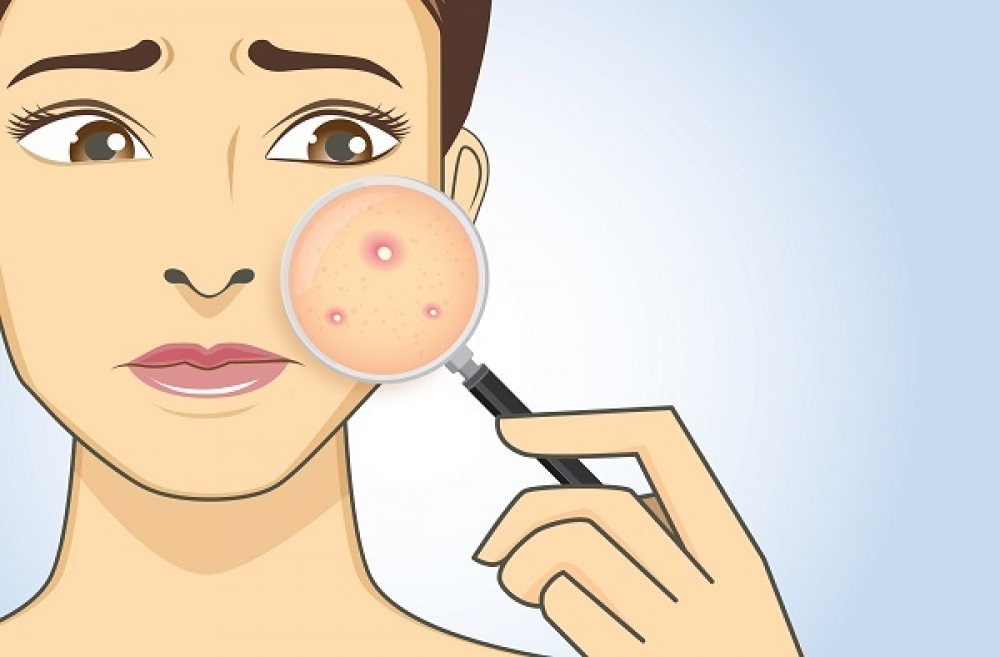 علاج حب الشباب Acne بأفضل الطرق الطبية و الطبيعية