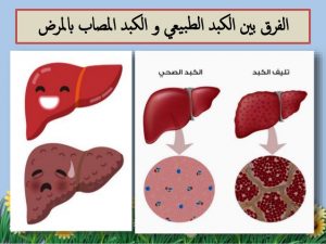اعراض الكبد الوبائي c v