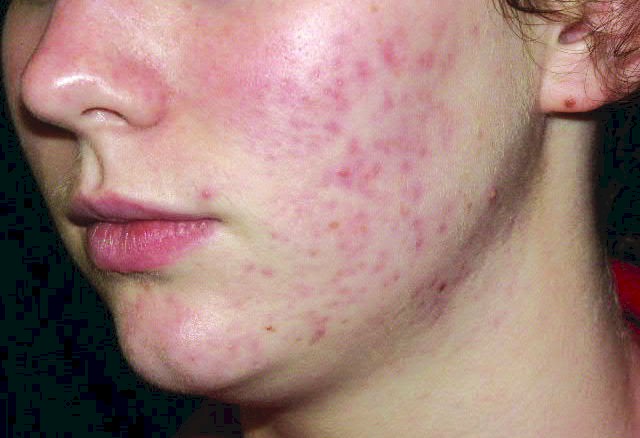 أعراض حب الشباب Acne