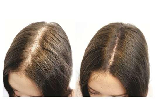 وصفة العرقسوس لعلاج حالات الصلع و تساقط الشعر