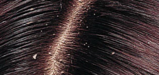 وصفة البنجر لعلاج قشرة الشعر