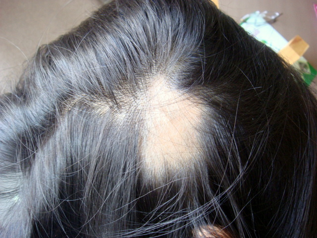 أعراض مرض الثعلبة Alopecia 