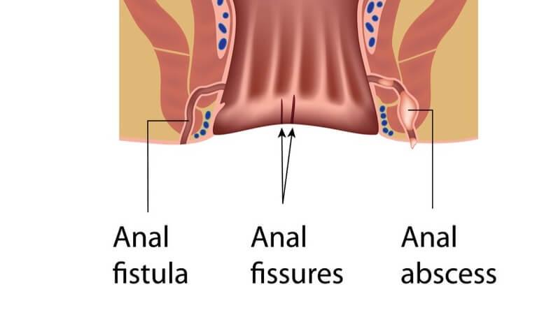 علاج الناسور الشرجي بالأعشاب الطبيعية