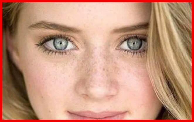 علاج النمش Freckles و البقع السوداء بطريقة منزلية