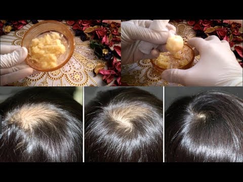 علاج مرض الثعلبة Alopecia بالطرق الطبيعية