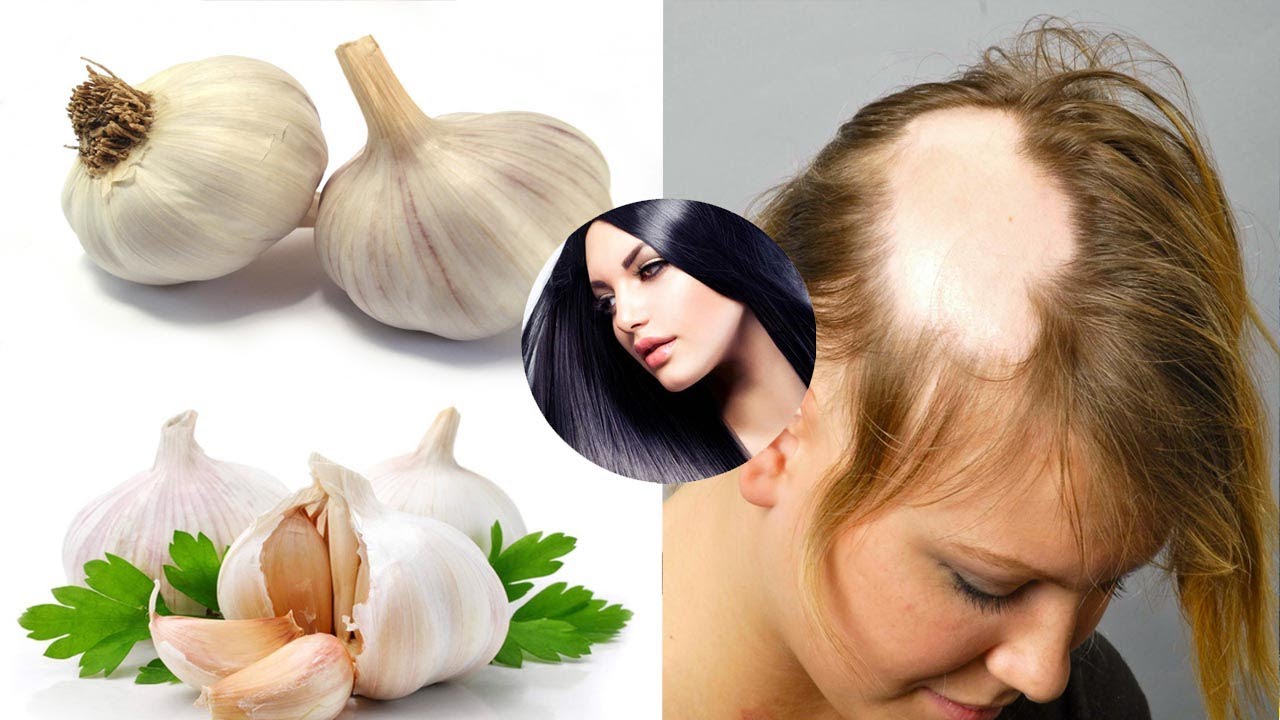 علاج الثعلبة Alopecia بأفضل الطرق الطبية و الاعشاب الطبيعية