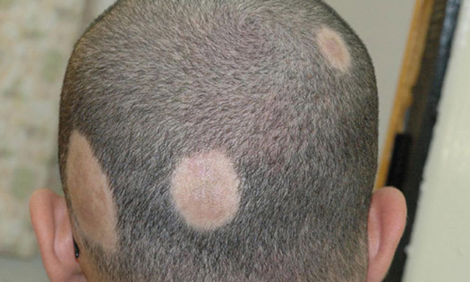 مناطق وجود الثعلبة Alopecia