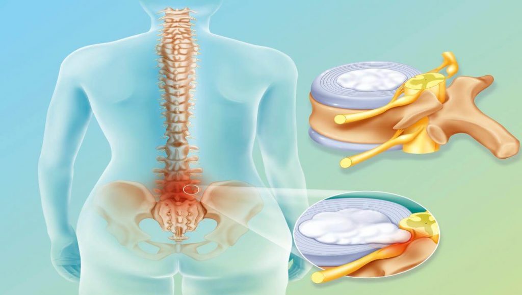 علاج عرق النسا بالأعشاب الطبيعية والطرق الطبية