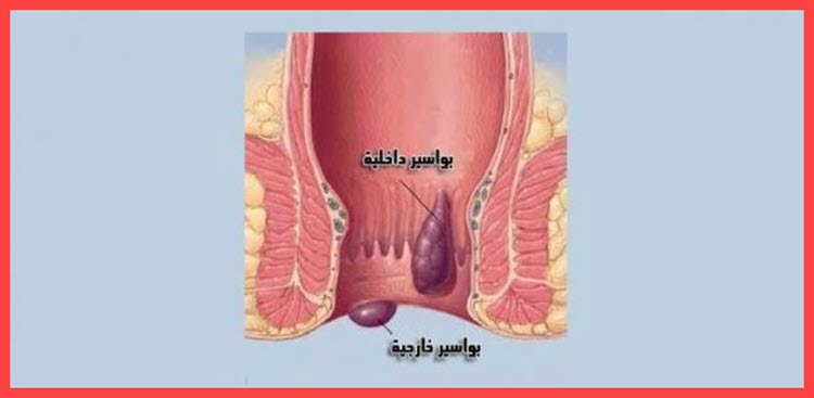 علاج البواسير Hemorrhoids بأفضل الطرق الطبية والأعشاب الطبيعية