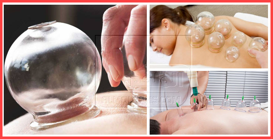 فوائد وأضرار الحجامة Cupping therapy للرجال والنساء