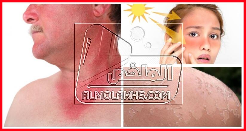 علاجات طبيعية لحروق الشمس