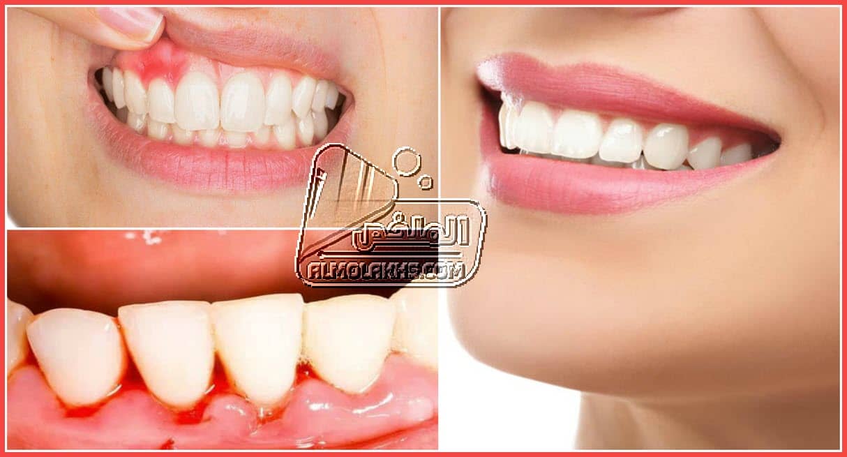 أدوية لعلاج إلتهاب اللثة والاسنان